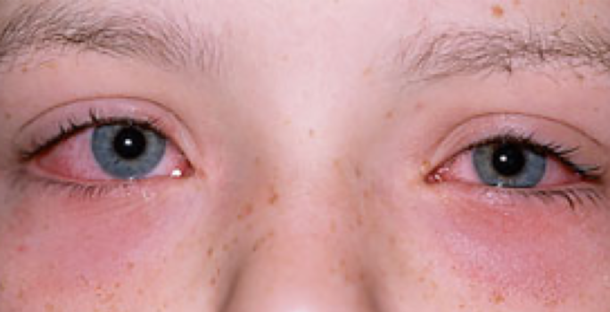 Barn som röda, rinnande ögon på grund av allergisk reaktion.
